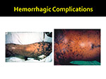 Hemorrhagic Complications