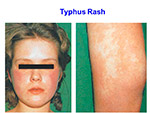 Typhus Rash