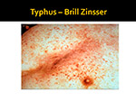 Typhus Brill Zinsser