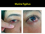 Murine Typhus