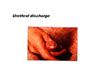 Urethral discharge