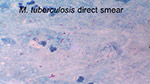 M tuberculosis