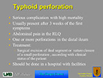  Typhoid perforation 