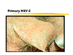  Primary HSV 2