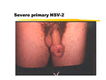  Severe Primary HSV 2