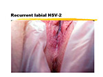 Recurrent labial HSV 2