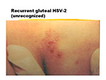 Recurrent gluteal HSV 2