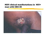 HSV clinical manifestations