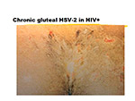 Chronic gluteal HSV2