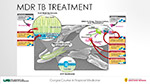 MDR TB Treatment