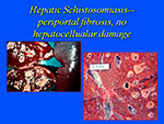 Hepatic Schistosomiasis