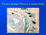 Chronic Bladder Fibrosis