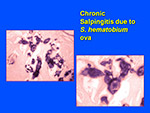 Chronic salpingitis