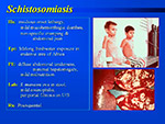 Schistosomiasis