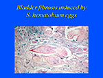 Bladder fibrosis