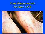 Avian Schistosomiasis