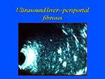 Ultrasound liver