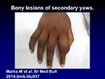 Bony lesions