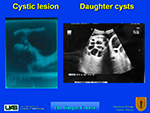 Cystic lesion