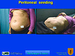 Peritoneal seeding