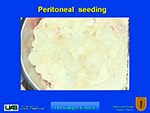 Peritoneal seeding