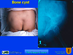 Bone cyst