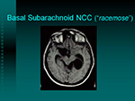 Basal Subarachnoid