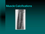 Muscle Calcifications