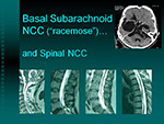 Basal Subarachnoid NCC