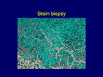  Brain Biopsy 