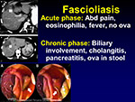 Fascioliasis