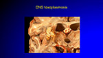  CNS toxoplasmosis