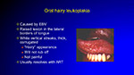 Oral hairy leukoplakia