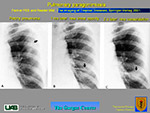  Pulmonary paragonimiasis 