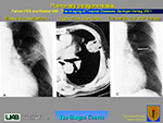  Pulmonary paragonimiasis 