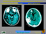  Cerebral paragominiasis 