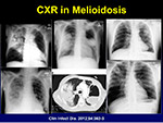 CXR in Melioidosis