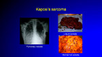 Kaposi s sarcoma