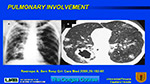  Pulmonary involvement 