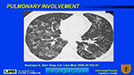  Pulmonary involvement 