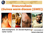 Dracunculiasis