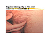 Inguinal adenopathy