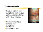  Trichomoniasis