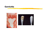 Cervicitis