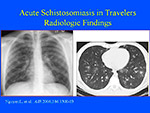 Acute Schistosomiasis